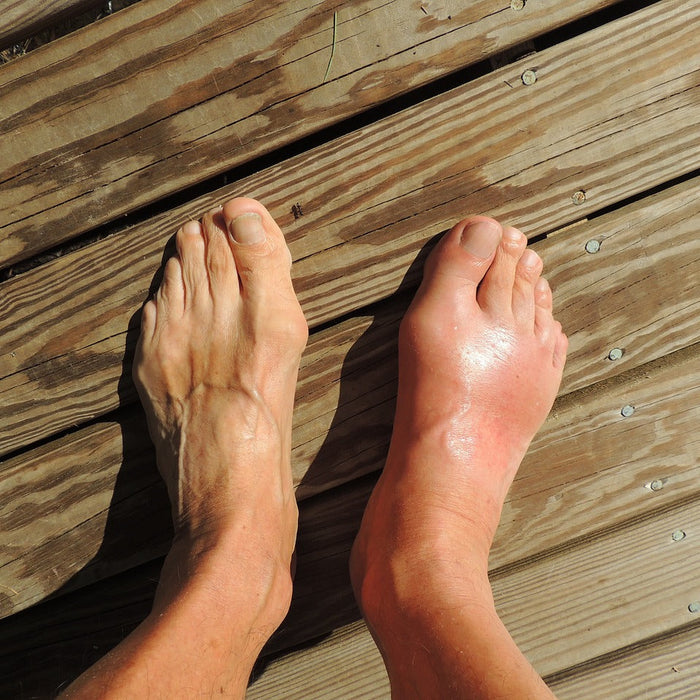 7 Easy Ways to Get Rid of Gout